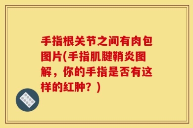 手指根关节之间有肉包图片(手指肌腱鞘炎图解，你的手指是否有这样的红肿？)
