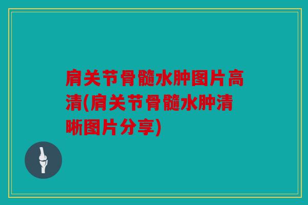 肩关节骨髓水肿图片高清(肩关节骨髓水肿清晰图片分享) 肩关节骨髓水肿图片高清(肩关节骨髓水肿清晰图片分享)